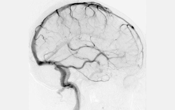 Cerebral angiography