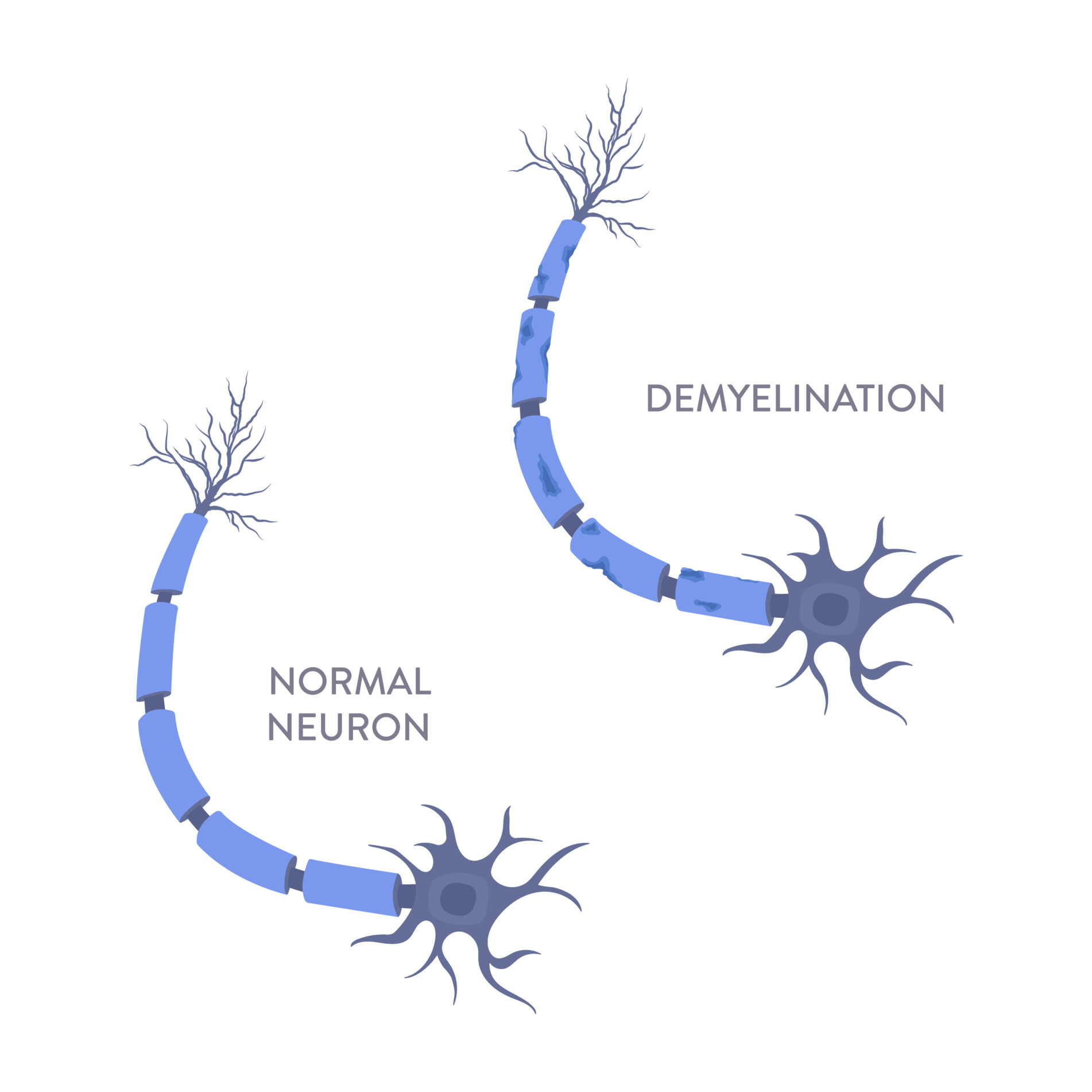 an image of a healthy neuron and one that has demyelination