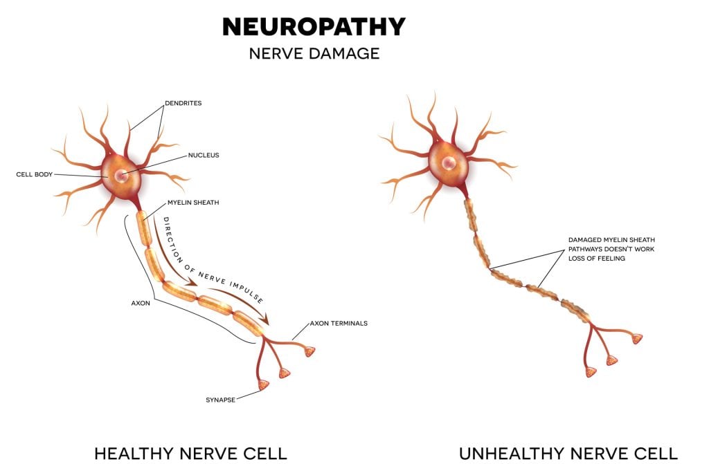 Neuropathy, nerve damage