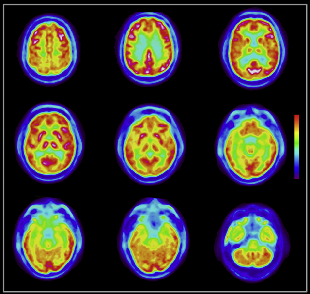 PET Scan image